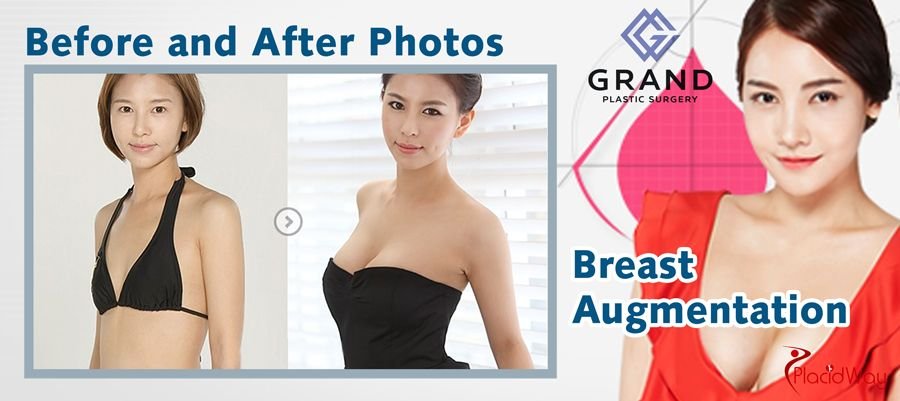 Breast Augmentation in Seoul, South Korea